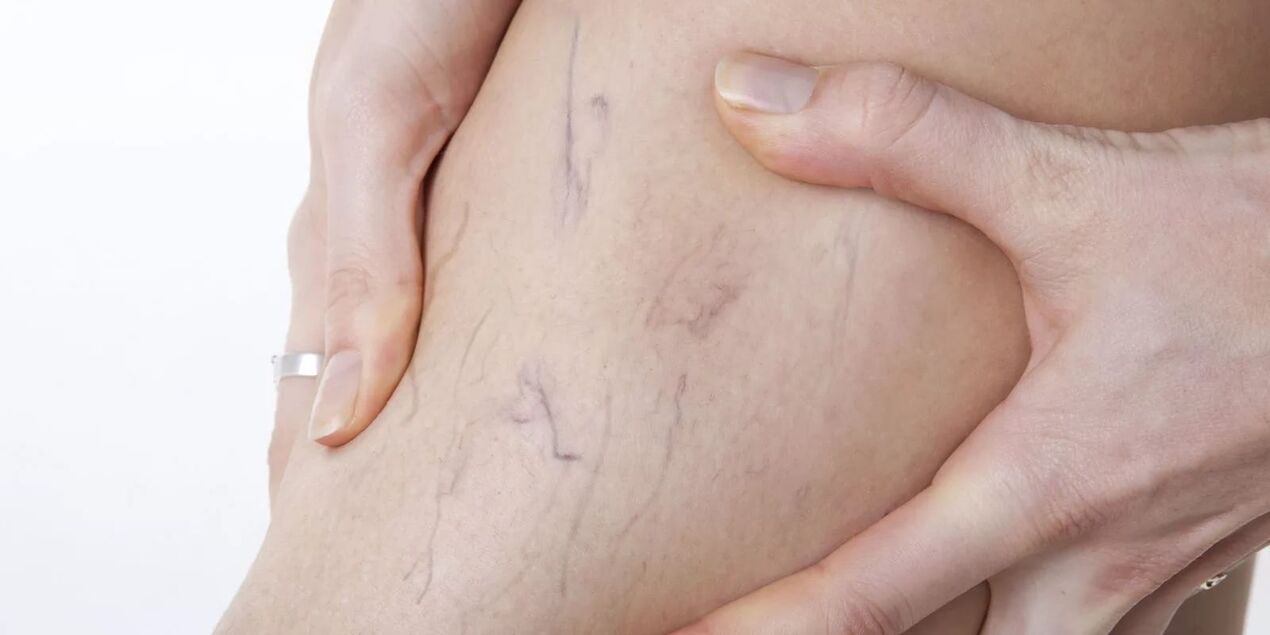 Before using varicose cream