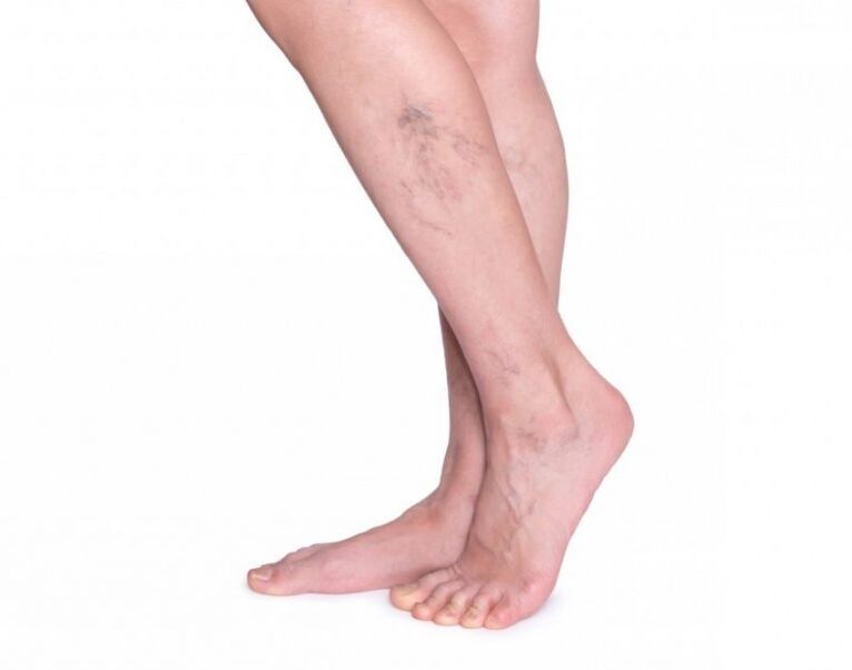 Different veins before treatment with Zxcvbnmqwort