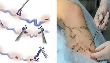 Flbectomy for varicose veins on the legs