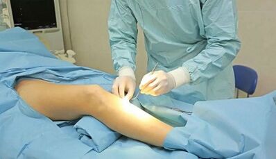 How is Operation with varicose veins performed