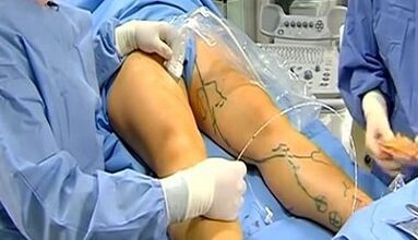 Work for varicose veins