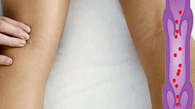 The reasons for the development of varicose veins of the lower limbs