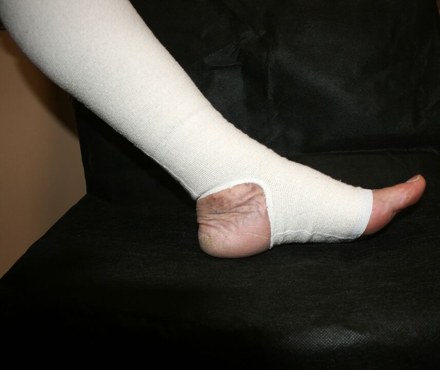 Compression knitwear for varicose veins