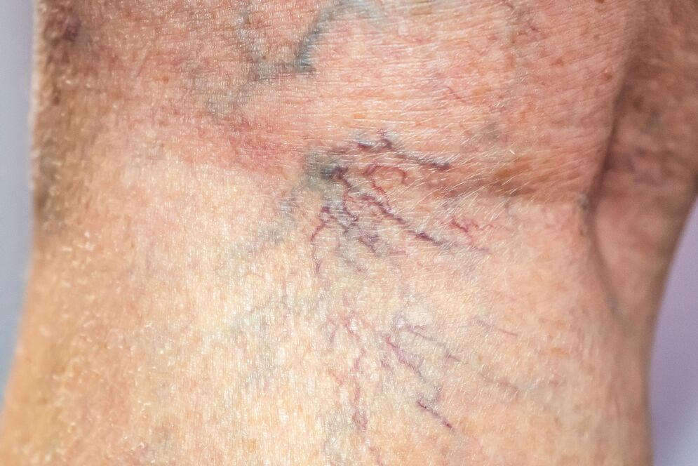 Different veins